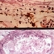Posterior Uveitis